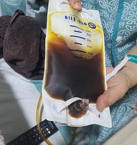 3일째담즙색깔