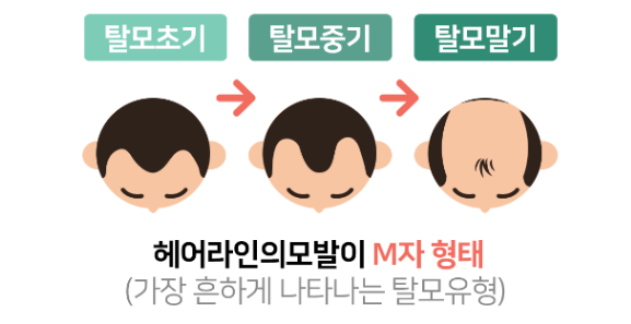탈모 M자의 형태 이미지