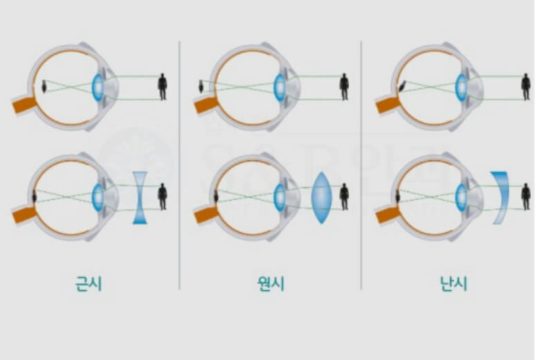 굴절 이상