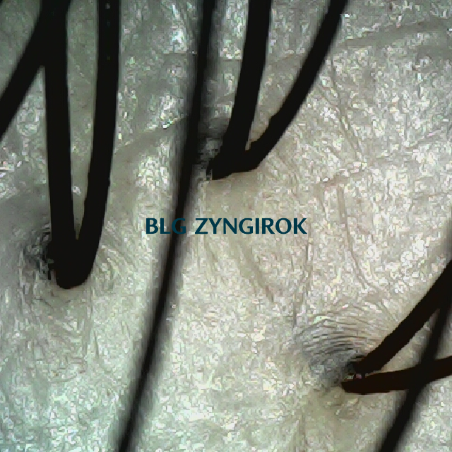 탈모 극복 프로젝트 - 70주차 뒷머리 두피 모습이다.