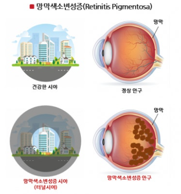 망막색소변성증의 유전적 원인, 증상,예방, 관리법 관련 이미지