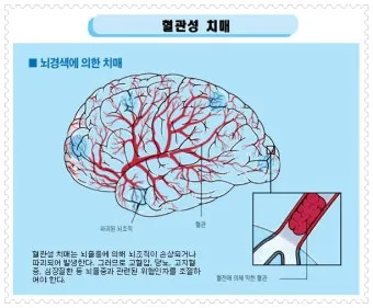 혈관성치매 원인 증상 치료법과 예방 생활습관_6