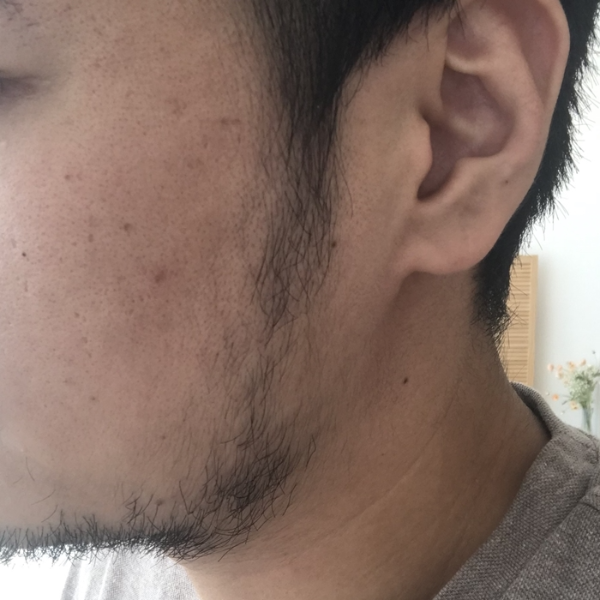 미녹시딜 수염 발모 3개월 차, 좌측 구레나룻과 턱 라인에 확실하게 자란 수염의 모습