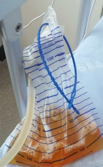 폐에 물이 차는 원인 증상 물참 관리 포인트에 대한 건강정보_16