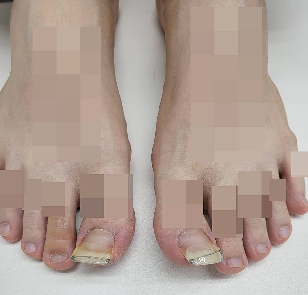 내성발톱-치료 후기