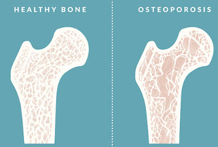 비타민 D 부족 증상