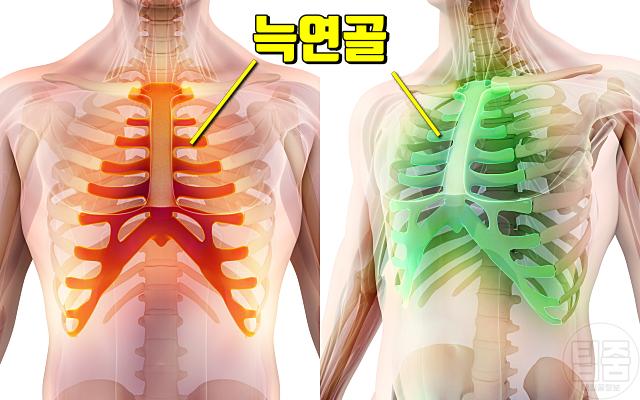러닝 가슴통증 원인 늑연골염