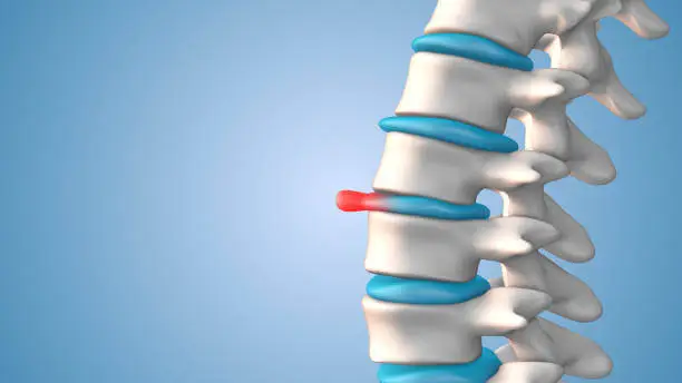 허리디스크-증상-단계