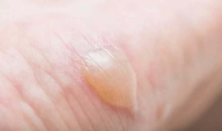 화상-응급처치법