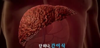 간이식 수술 성공적