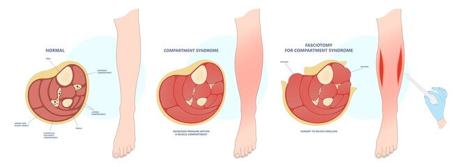 횡문근융해증 원인, 증상, 검사법, 치료법까지 자세히 알아봤습니다. 횡문근융해증은 이름이 생고하고 낯선 질병일 수 있는데요~ 운동을 즐겨하시는 분들이라면 꼭 숙지하면 좋을 거 같습니다!