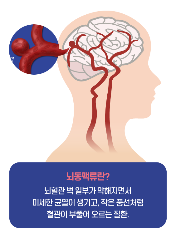 뇌동맥류 증상