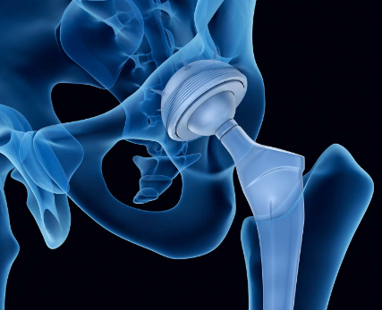 고관절 인공관절 삽입 모습