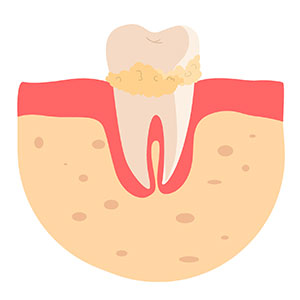 잇몸-염증-치석