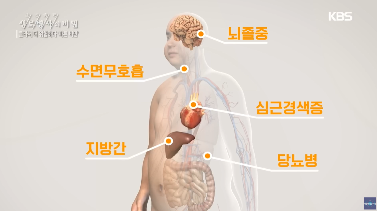 BMI 체질량지수 마른비만 체지방률 내장지방 간식중독 지바간 당뇨병 뇌졸증 수면무호흡 식습관