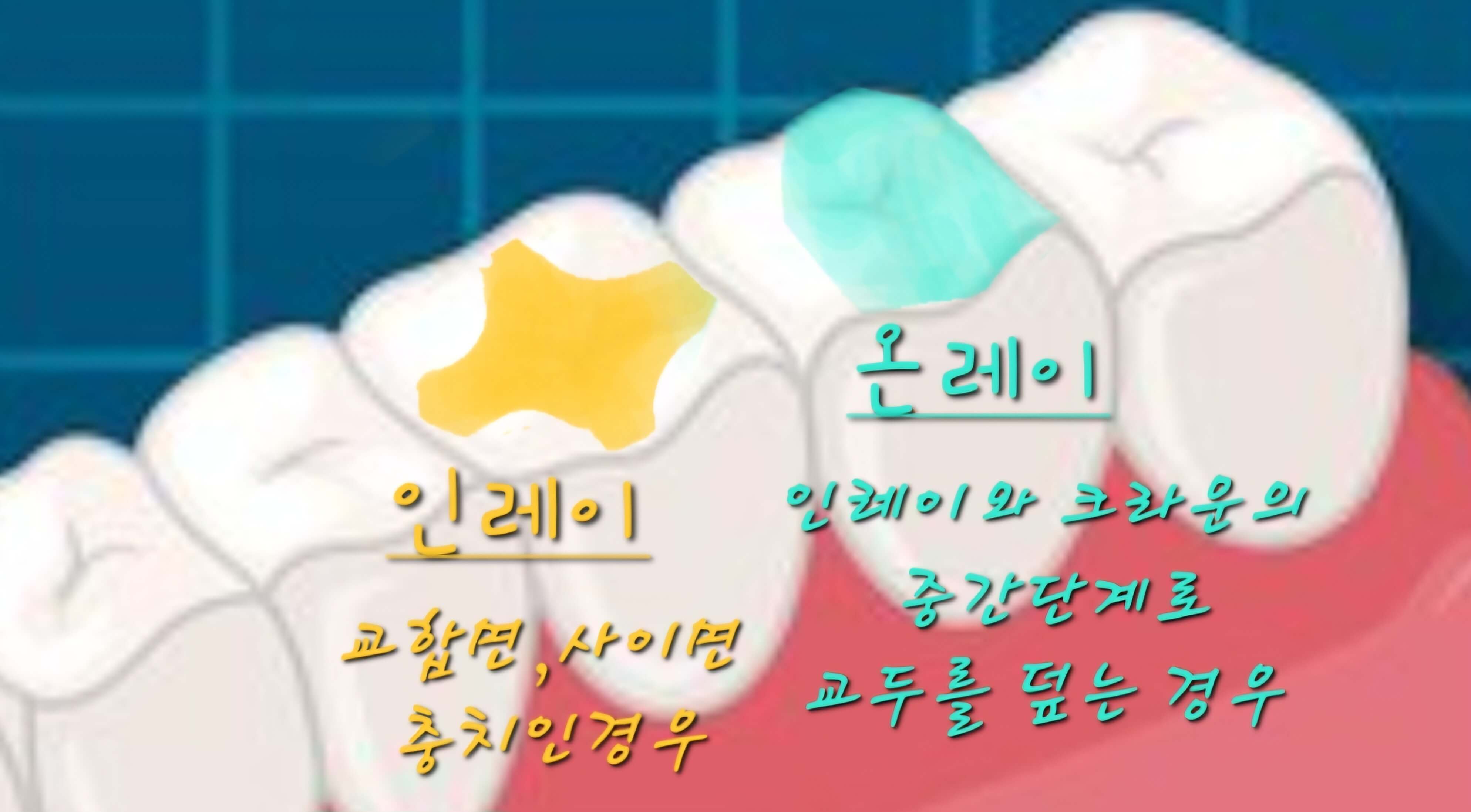 인레이 온레이 정의