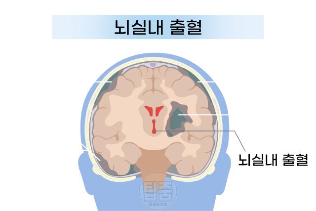 뇌혈관 터짐 위치 뇌출혈 종류 뇌실내출혈