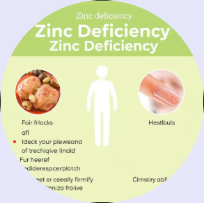 아연 결핍 증상,
아연 부족 원인,
아연 결핍 치료 방법,
아연 결핍 예방 자연식품,
아연 흡수 개선 음식,
아연 결핍 검사,
아연 부족 면역력,
아연 결핍 탈모,
아연 결핍 성장 지연,
아연 결핍 어린이,