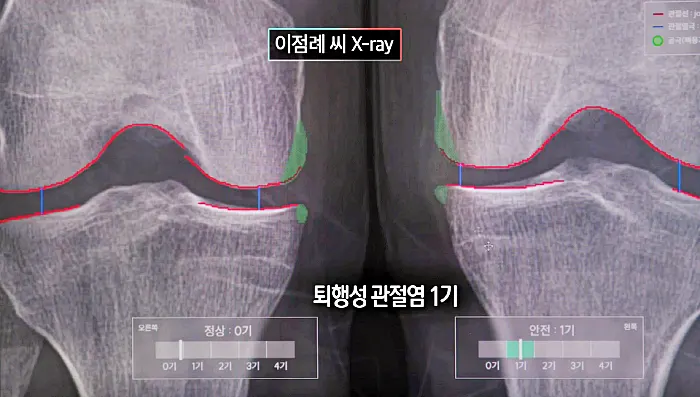 생로병사의 비밀 871회 무릎통증, 퇴행성 관절염, 무릎이 망가지는 습관과 원인, 건강한 무릎 지키기 정보 방법