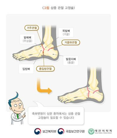 유전성 운동 및 감각 신경병증(HMSN, 샤르코-마리-투스병) 원인&middot;증상&middot;치료 가이드