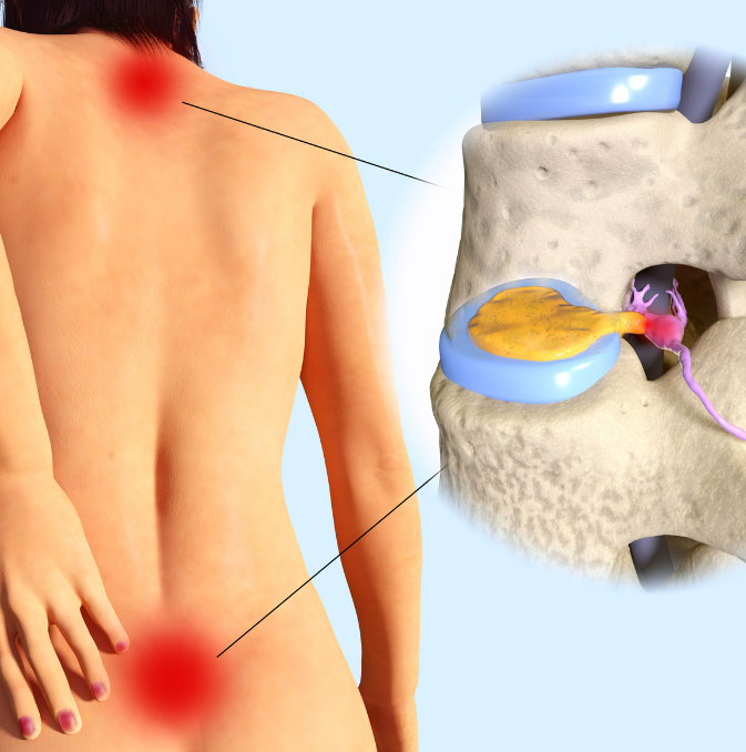 허리 삐끗 햇을때