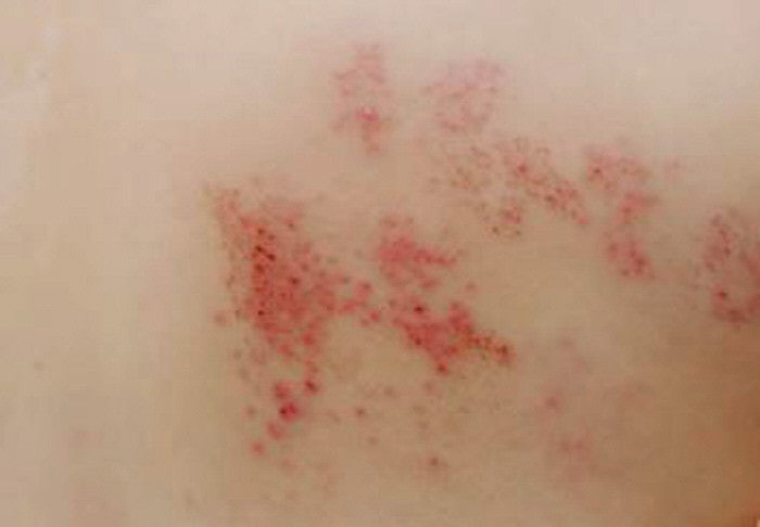 대상포진 환자의 환부