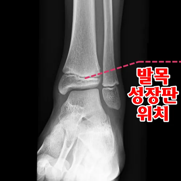 성장판 닫혀도 키 클 수 있는 방법과 성장 호르몬 시기_3