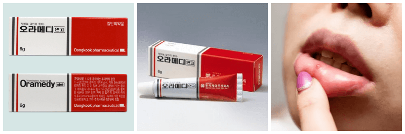 오라메디 연고, 구내염 사진