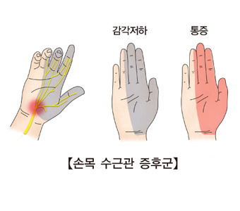 손목터널증후군 증상&middot;원인&middot;치료
