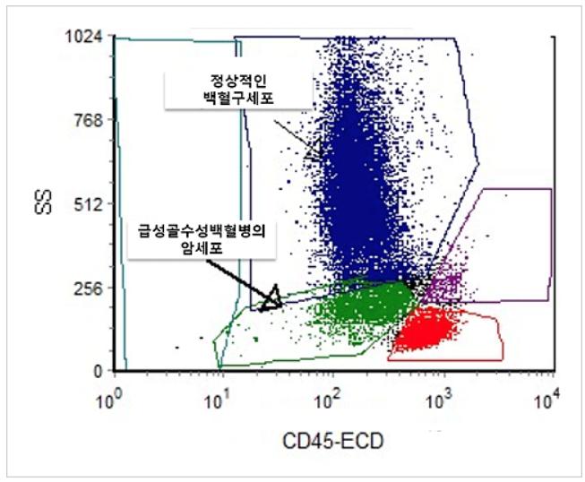 급성골수성백혈병 원인&#44; 증상&#44; 진단&#44; 치료방법