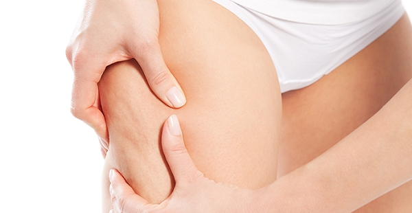 셀룰라이트 없애는 법