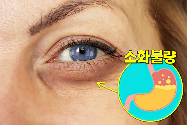 다크서클 소화가 잘 안될때 나타나는 증상, 소화불량 증상, 팁줌