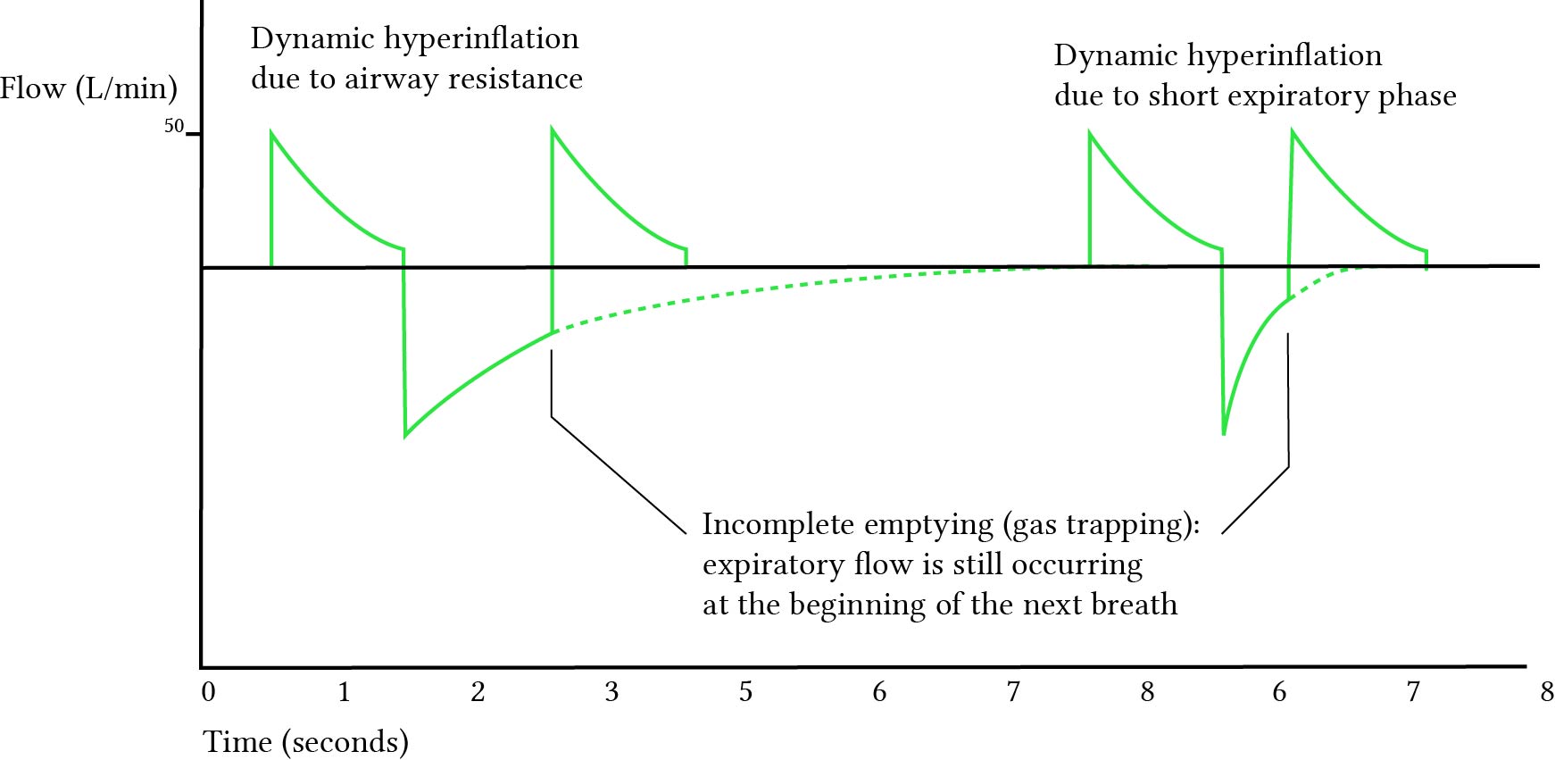 ventilator air trapping, gas trapping