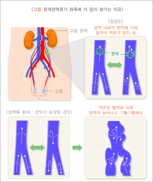 정계 정맥류가 좌측에 잘 생기는 이유