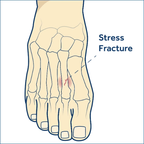 발가락 피로골절
