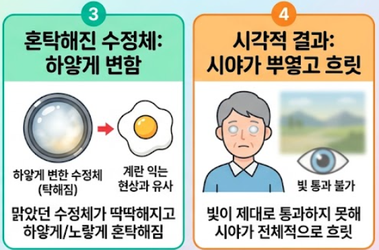 백내장 수술