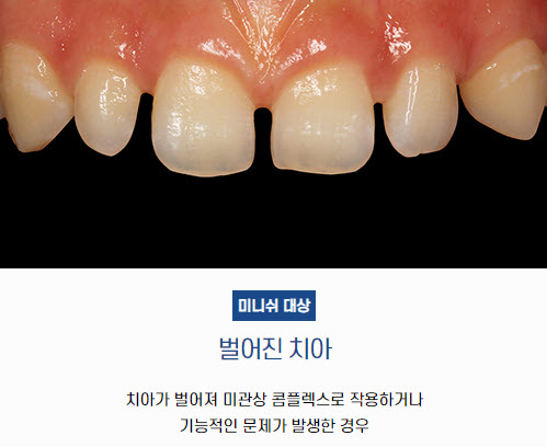 벌어진 치아