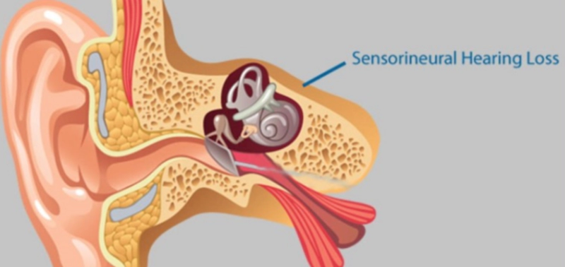 돌발성 난청 증상 4가지