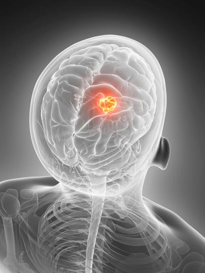 뇌종양: 원인, 증상 및 치료