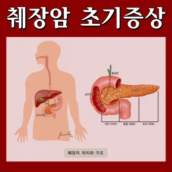 췌장암 초기 증상 췌장암 등통증 위치 검사_19