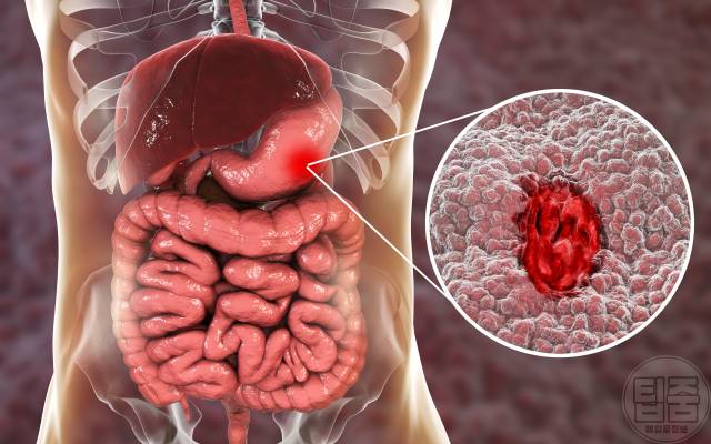 감식초효능 감식초매일먹으면 위암 대장암 간암