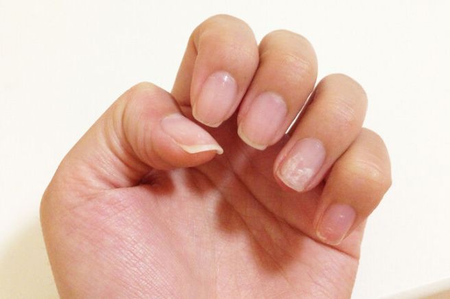 손톱 세로줄 무늬