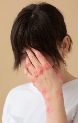 피부 붉은반점 27