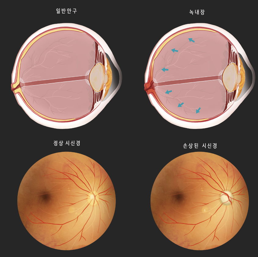 녹내장 초기증상 11가지 총정리 섬네일