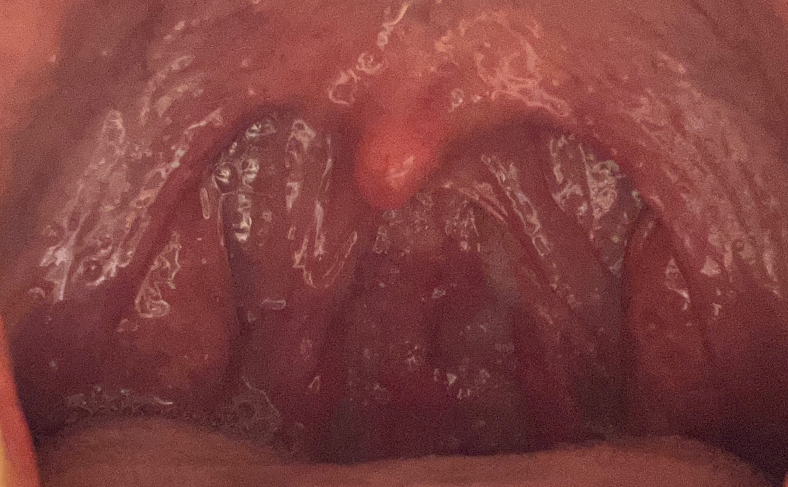 편도 절제 수술 전