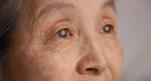 5060세대 눈 건강, 백내장 주의보