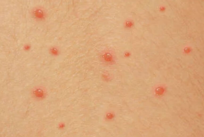 대상포진 초기증상 대상포진 조기치료 대상포진 초기증상 및 조기치료