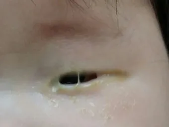 눈물샘 뚫는 수술 간단한가요에 대한 수술정보_13