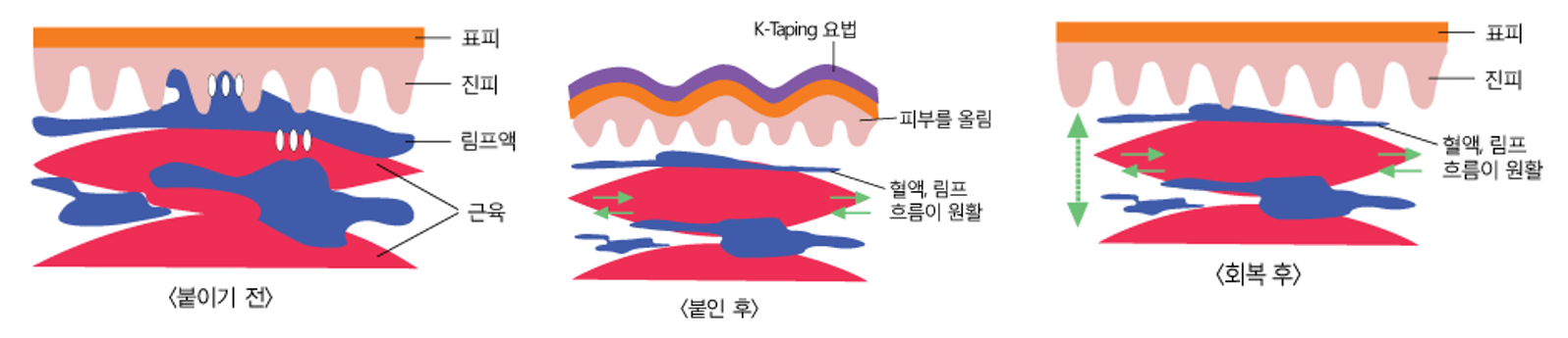 테이핑의 원리