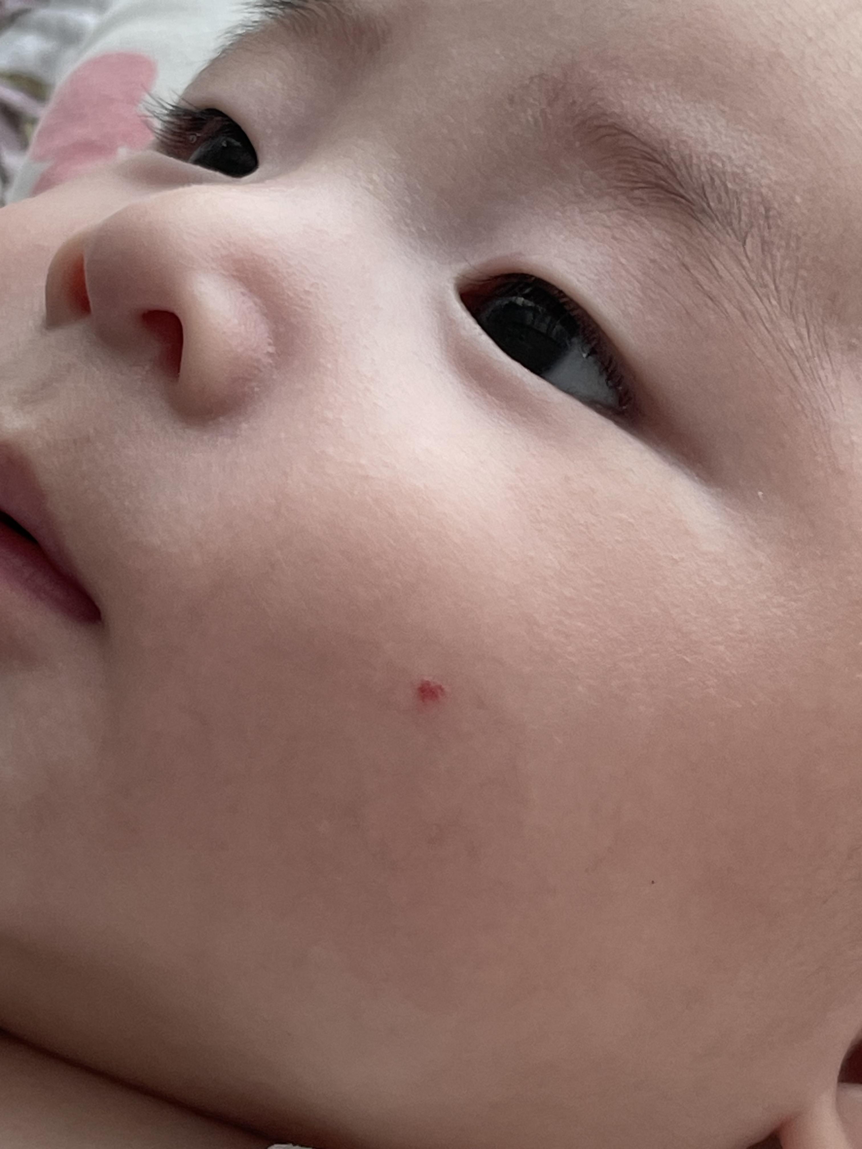 혈관종 에스앤유 피부과